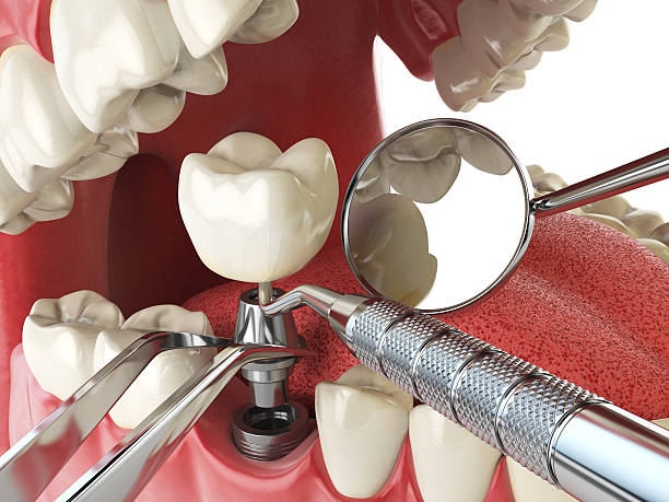 Best Emergency Treatment for Dental Infections or Abscesses in Kingston Estates, NJ